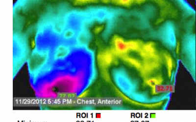 Thermography – Radiation-Free Breast Evaluation